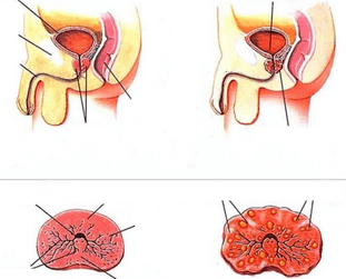 prostata normala eta prostatitis kronikoa