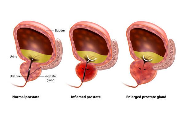 prostatitisa prostatako guruinaren hantura da