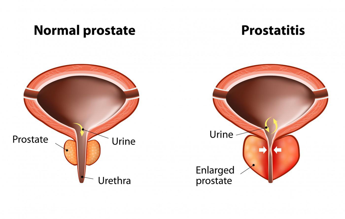 Gizon osasuntsu baten prostata normala eta prostatako guruinaren hantura prostatitisarekin
