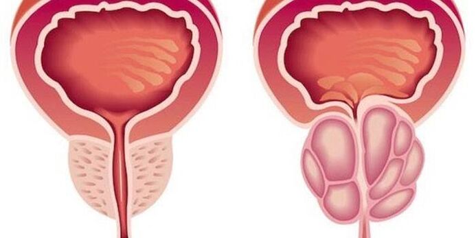 prostatitis