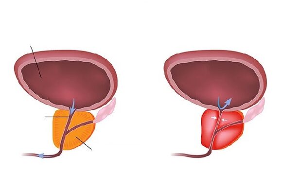 prostata normala eta hanturatua
